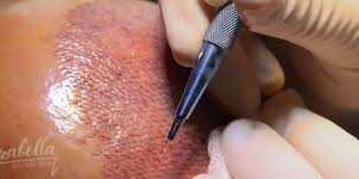 يبحث البعض عن بديل زراعة الشعر